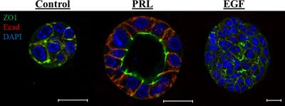 Terminal differentiation and anti-tumorigenic effects of prolactin in breast cancer